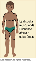 duchenne